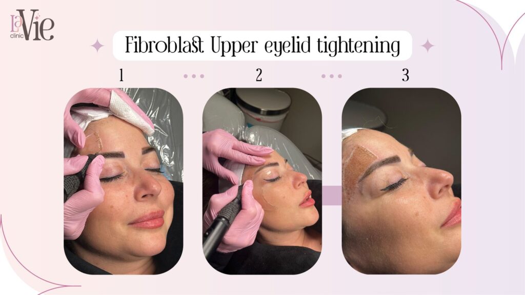 Fibroblast-Upper-eyelid-tightening before and after