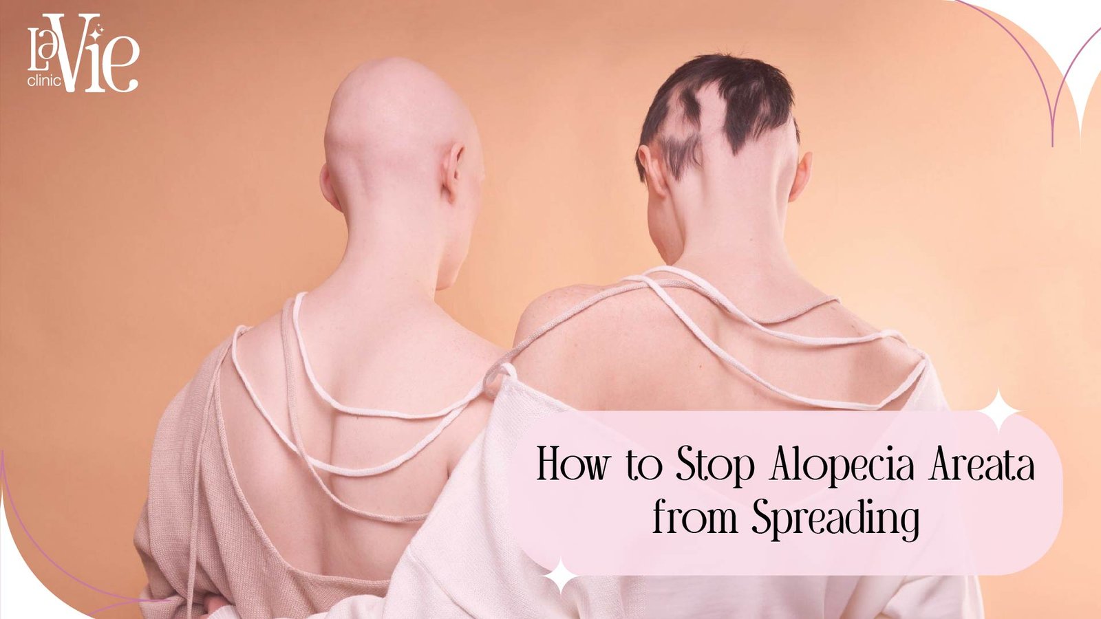 How to Stop Alopecia Areata from Spreading