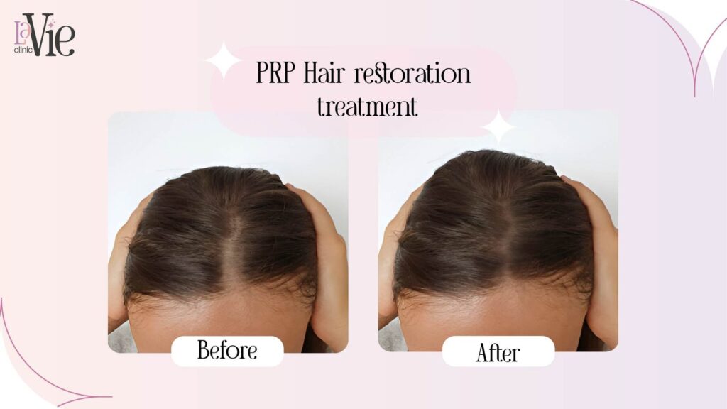 prp hair restoration treatment