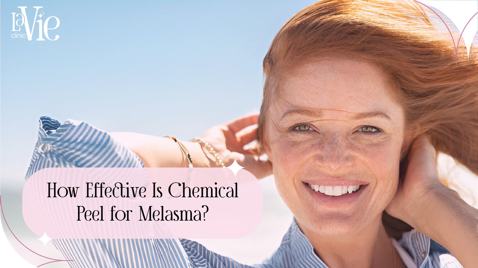Chemical Peel for Melasma