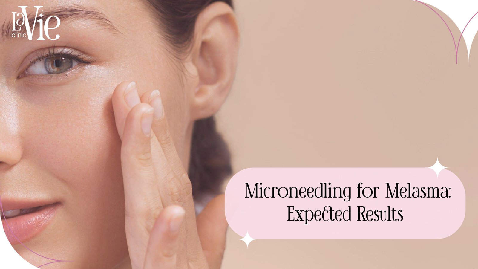 microneedling for melasma
