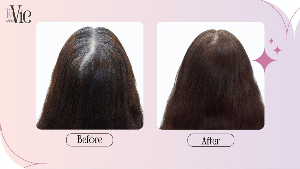 B12 Shots and PRP for Hair restoration 3