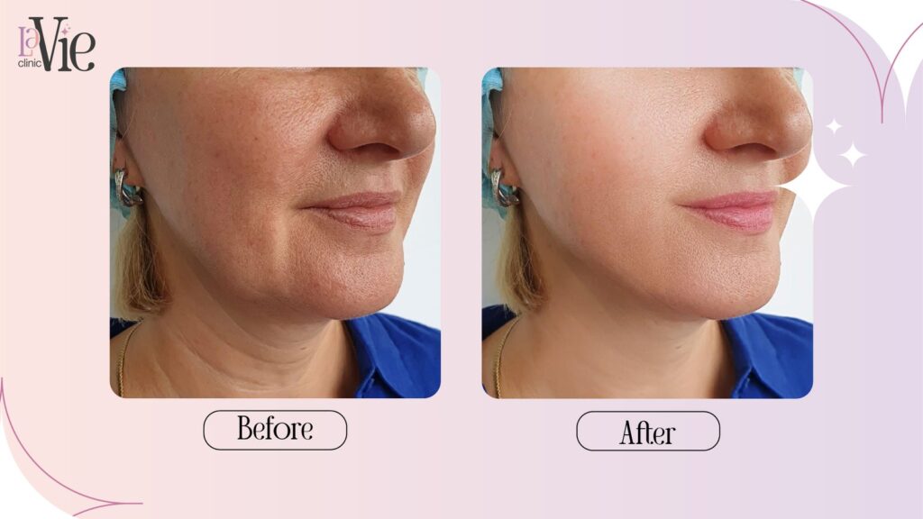 BBL & Moxi skin treatment for sun damaged