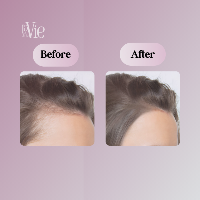 Our Proven PRP Hair Restoration Process