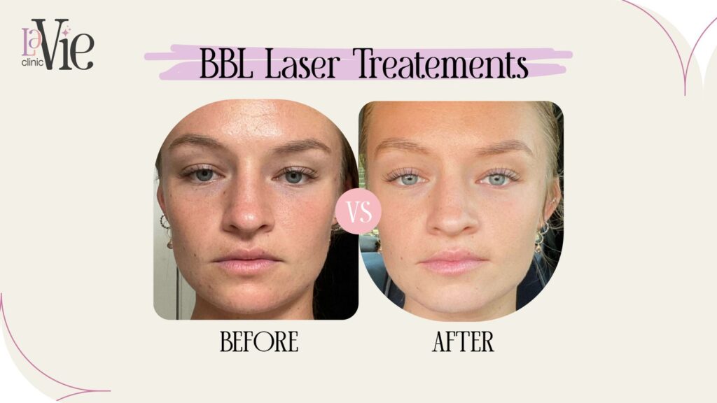 BBL laser treatment before and after