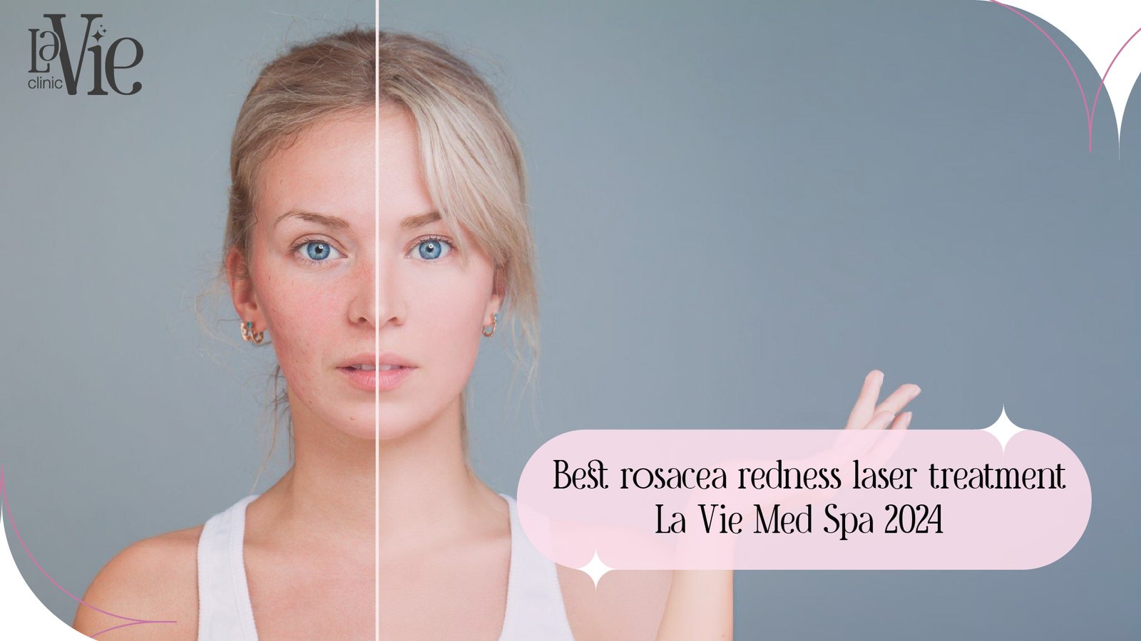 Best-rosacea-redness-laser-treatment-La-Vie-Med-Spa-2024