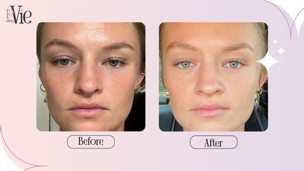 Chemical peel with PRP & Microneedling for Dull Face skin before and after transformation