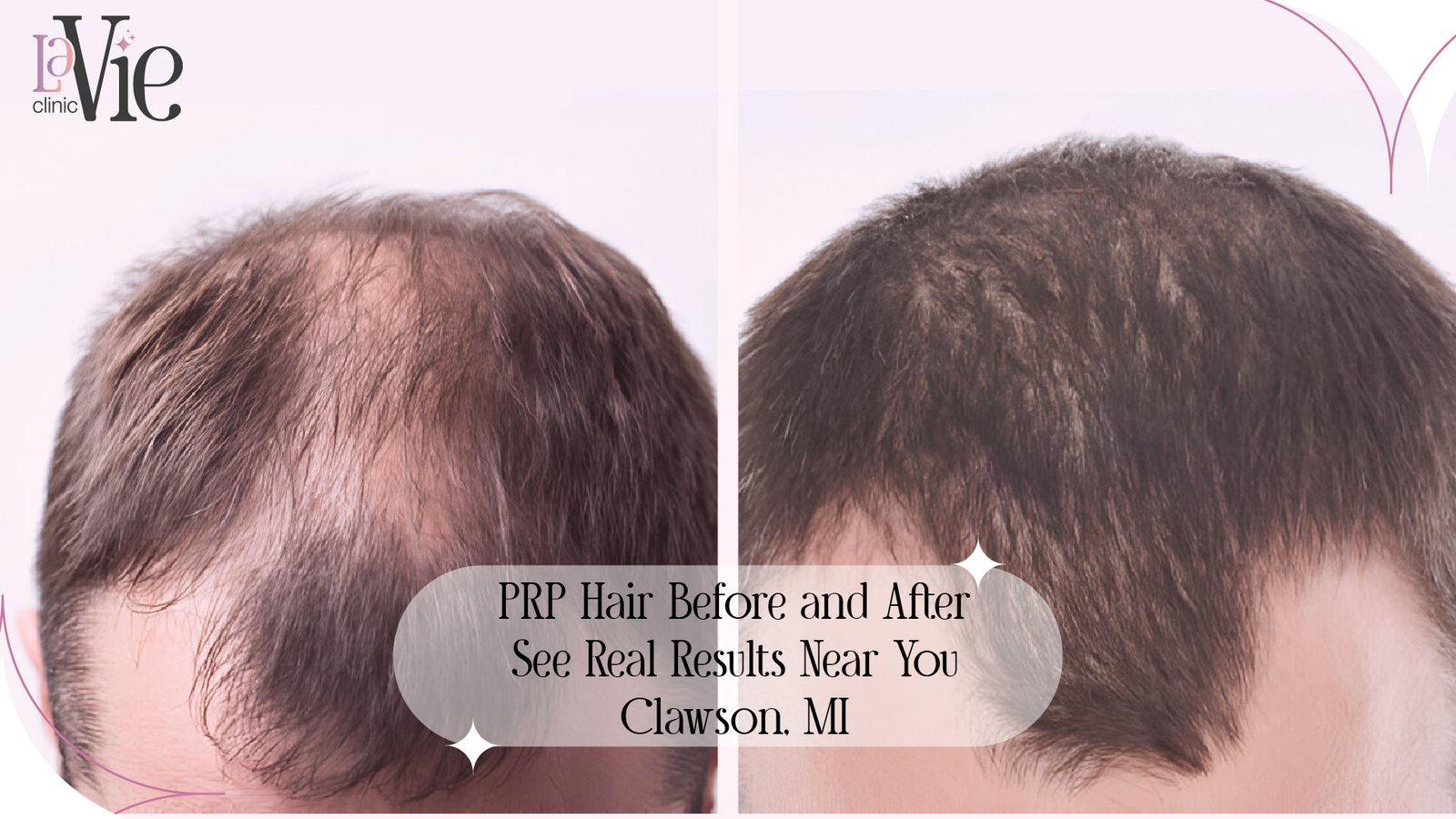 PRP Hair Before and After Success Stories in 2024 | Near Clawson, MI