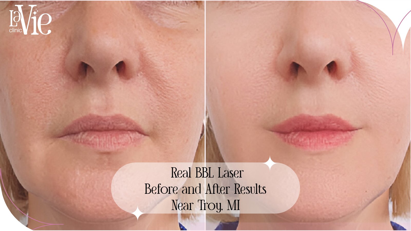 Jaw-Dropping BBL Laser Before and After Results in Rochester Hills MI