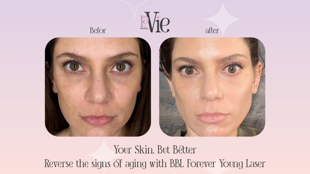 BBL-Forever-Young-Laser for sun damaged skin and Dull Face skin