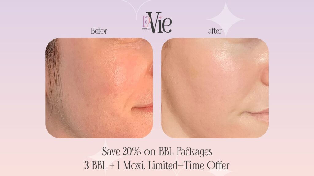 Better Skin in 3 Sessions