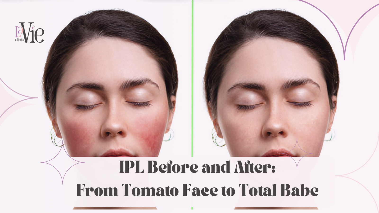 IPL Before and After: From Tomato Face to Total Babe at La Vie Med Spa