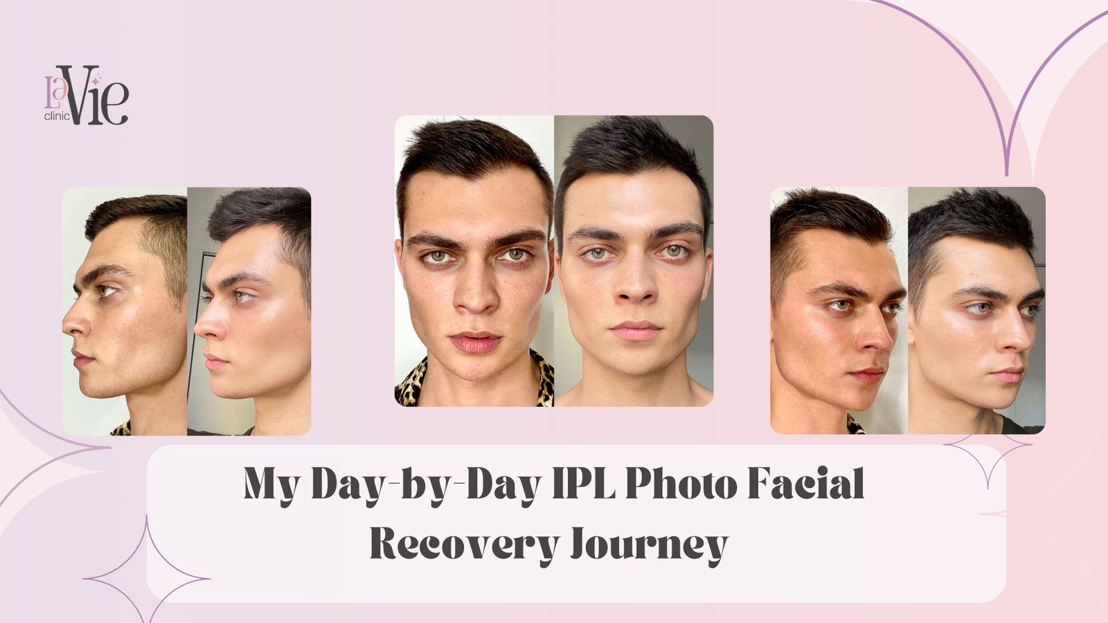 My Day-by-Day IPL Photo Facial Recovery Journey for sun damaged skin -La Vie 2025