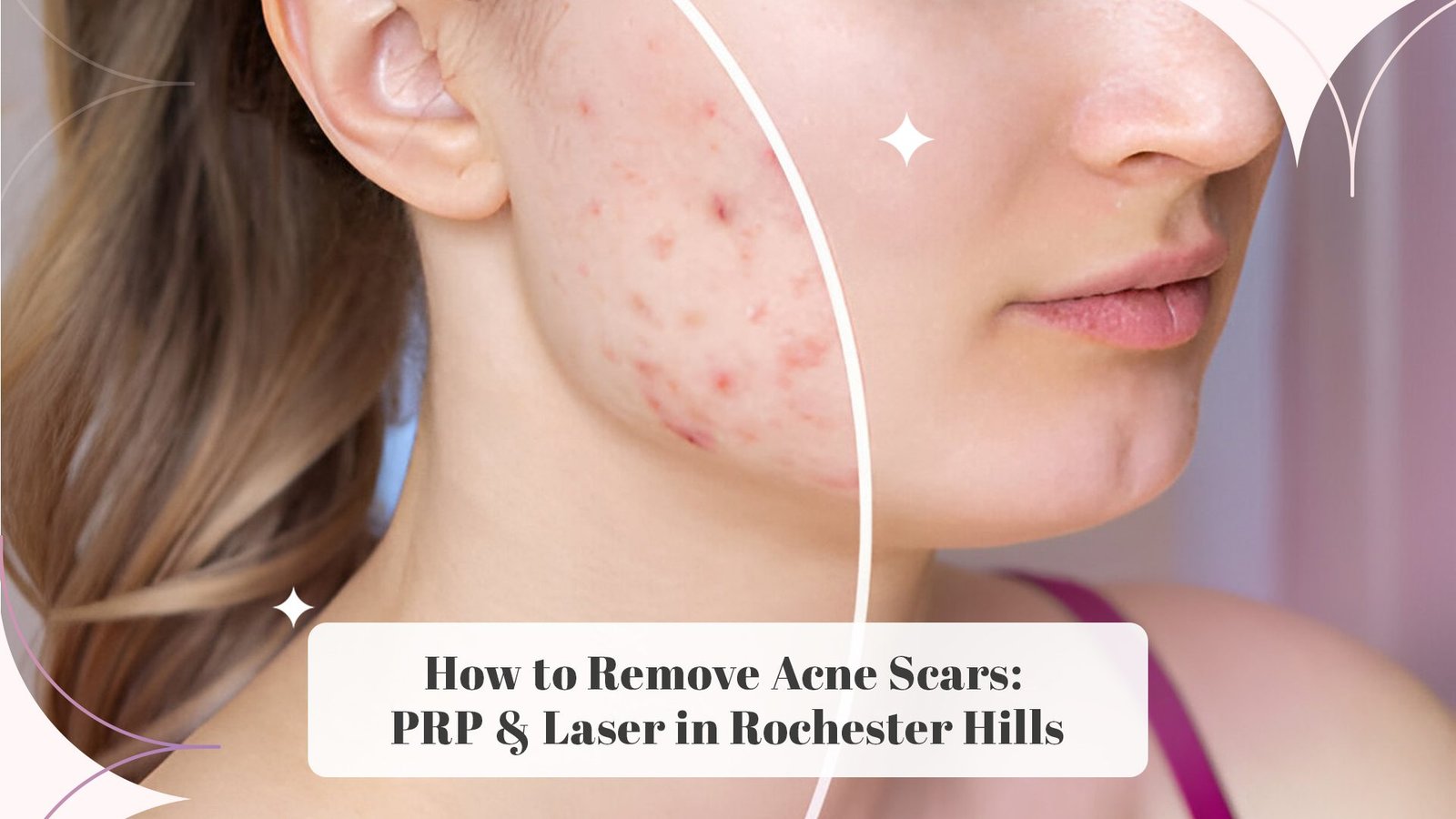 How to Remove Acne Scars: PRP & Laser in Rochester Hills