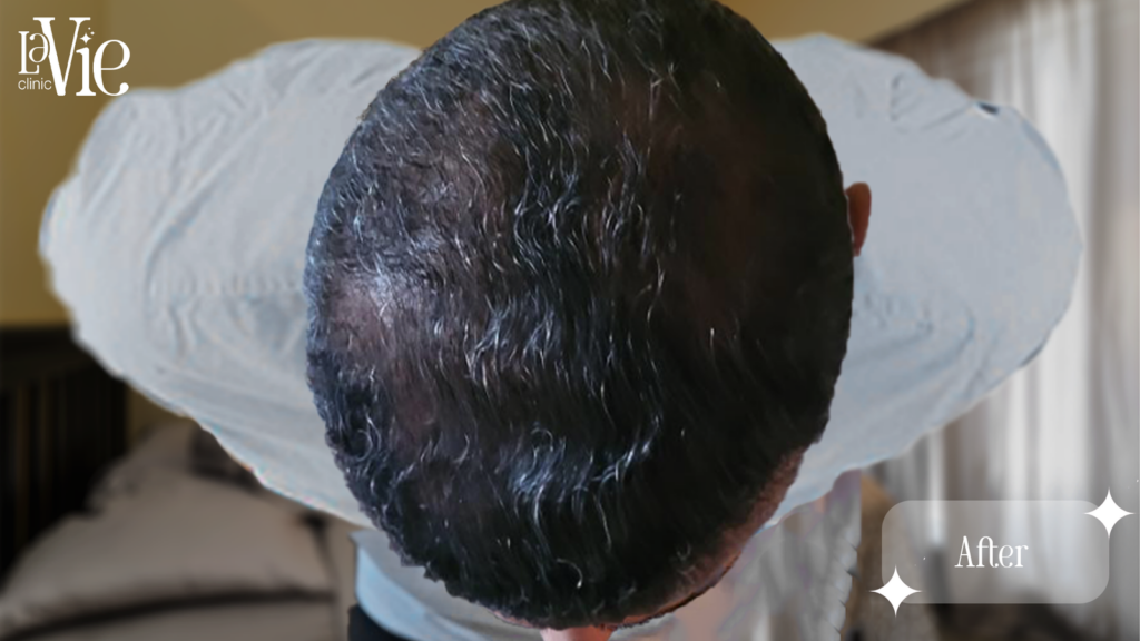 PRP Hair restoration after 6 months - La Vie Med Spa Rochester Hills Mi