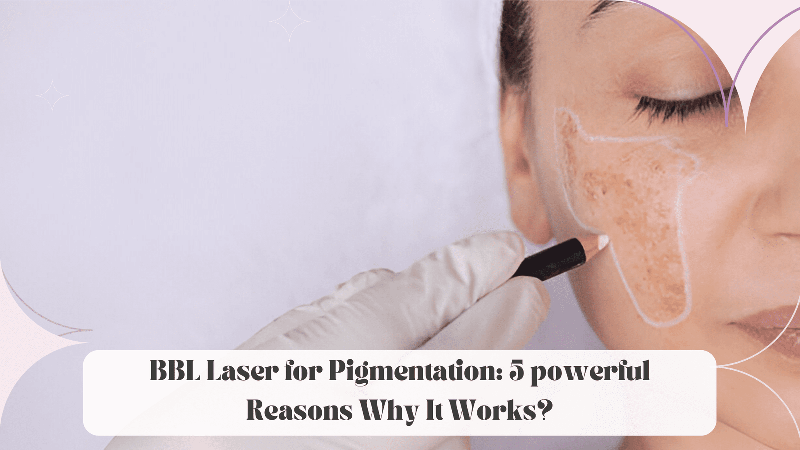 BBL Laser for Pigmentation: 5 powerful Reasons Why It Works?