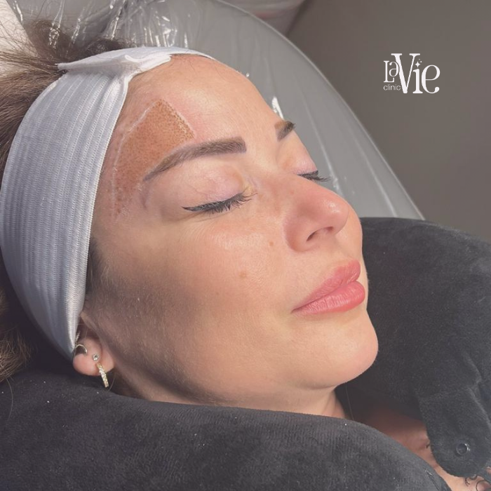Laser Resurfacing for Enlarged Pores
