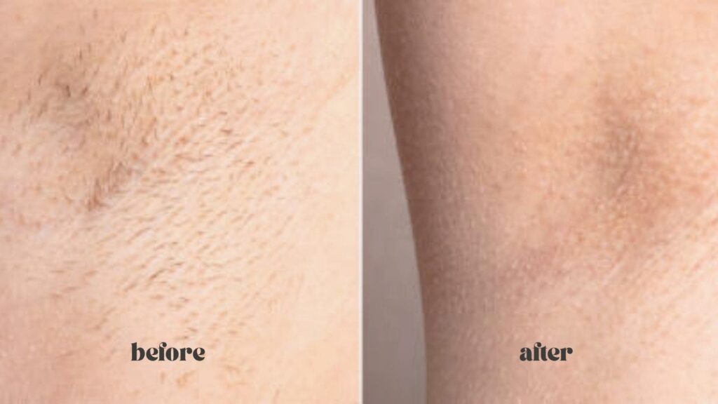 Jasmine, Model from Rochester Hills – laser hair removal black Friday deals for women