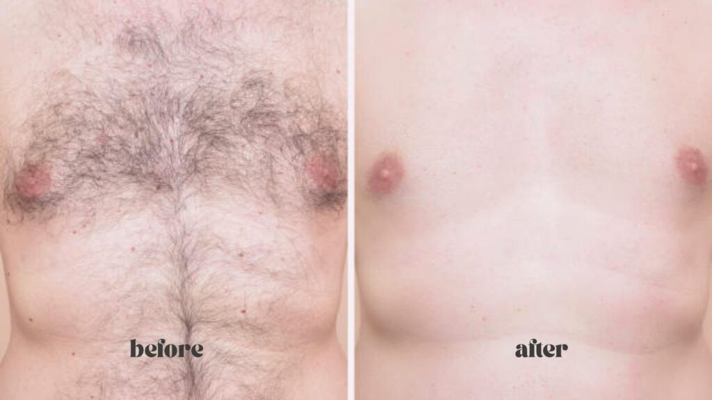 Mario, 45, Athlete from Troy, MI - Laser hair removal black Friday before and after