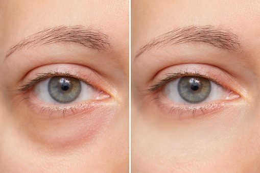 Eye bags mesotherapy in Rochester Hills reduces fat and fluid under eyes using mesotherapy before and after image