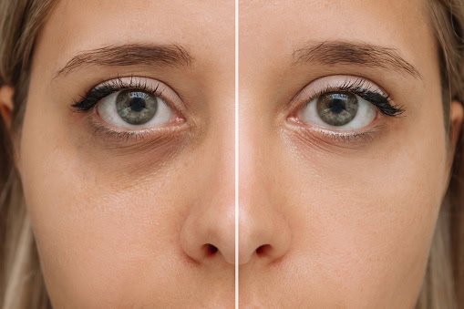 Woman with mesotherapy under eye refreshed results for 12-18 months or more. Periodic touch-up sessions may be recommended to sustain your optimal appearance and combat ongoing environmental factors specific to Michigan.