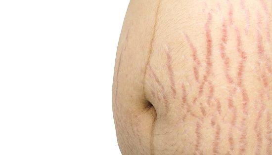 Red or Purple Stretch Marks (Striae Rubrae) - Pregnant woman with cracks on skin texture isolated on white