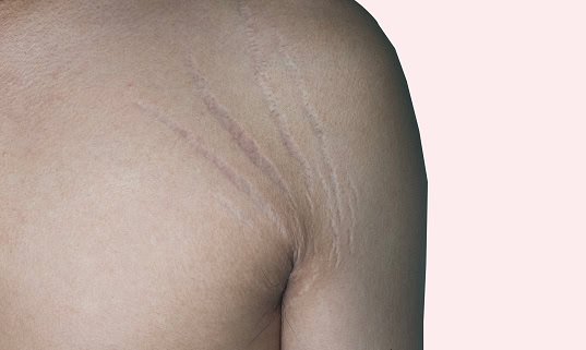 White or Silver Stretch Marks (Striae Albae) - close up stretch marks on man armpit skin area