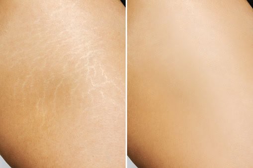 Before and after Stretch marks treatment using Rf Microneedling - Close up of a young woman's thigh with white stretch marks from a weight loss