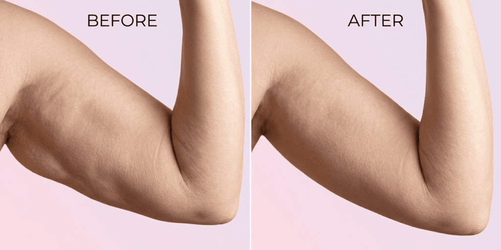 Man Arm before and after Loose skin treatment with Fibroblast and Microneedling - Loose fold visibly reduced by approximately 35–45%