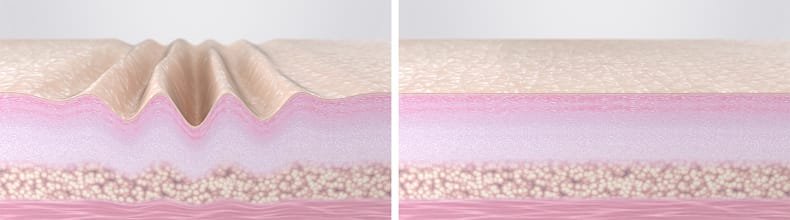 Loose skin treatment to help with collagen production after weight loss of post-pregnancy
