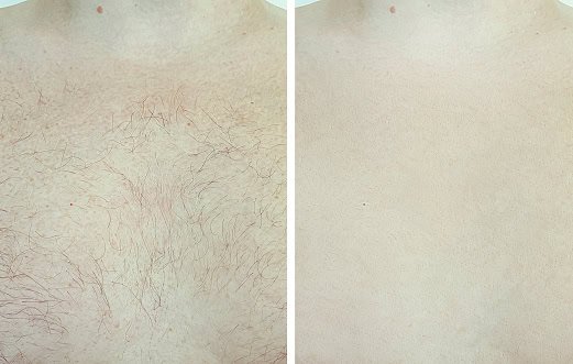 male chest hair before and after Forever Bare BBL Laser hair removal