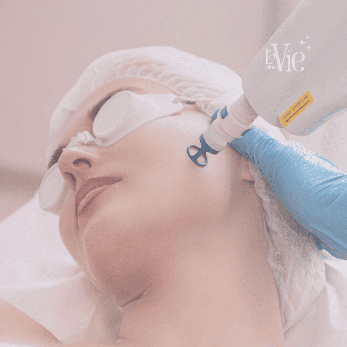 Acne Pigmentation Laser Treatment