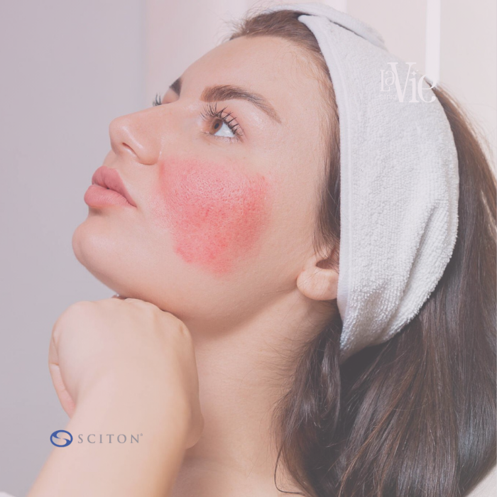 BBL for Rosacea
