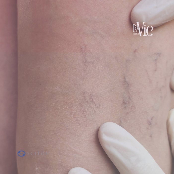 BBL & Clear Silk for Venous Malformations