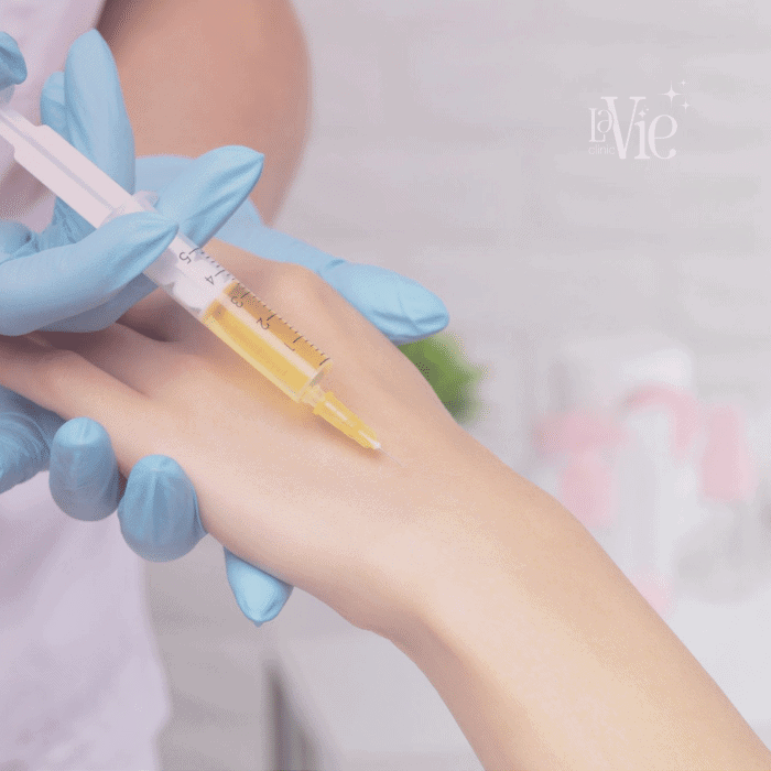PRP Hand Rejuvenation