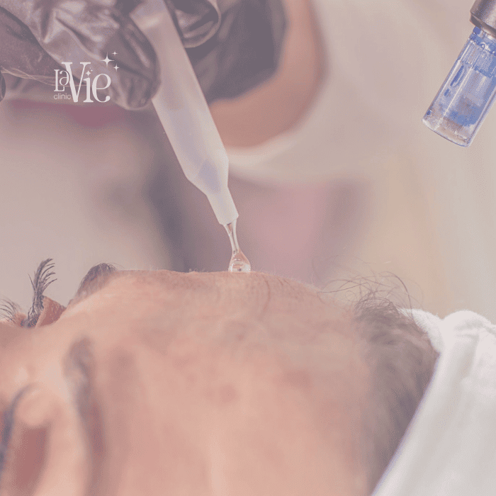 Combo Microneedling BioRePeel / PRX