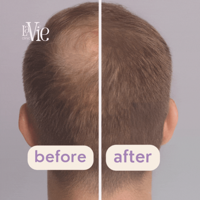Mesotherapy for Hair Restoration