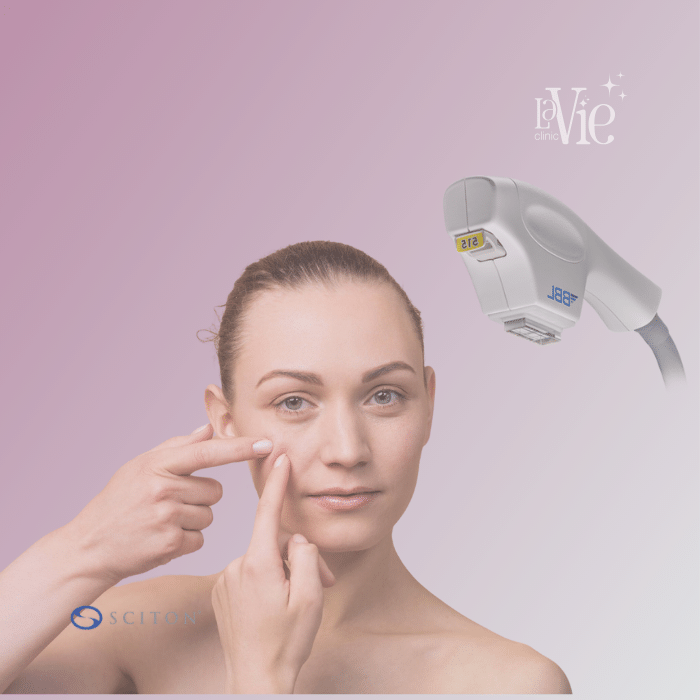 Forever Clear BBL Acne Treatment