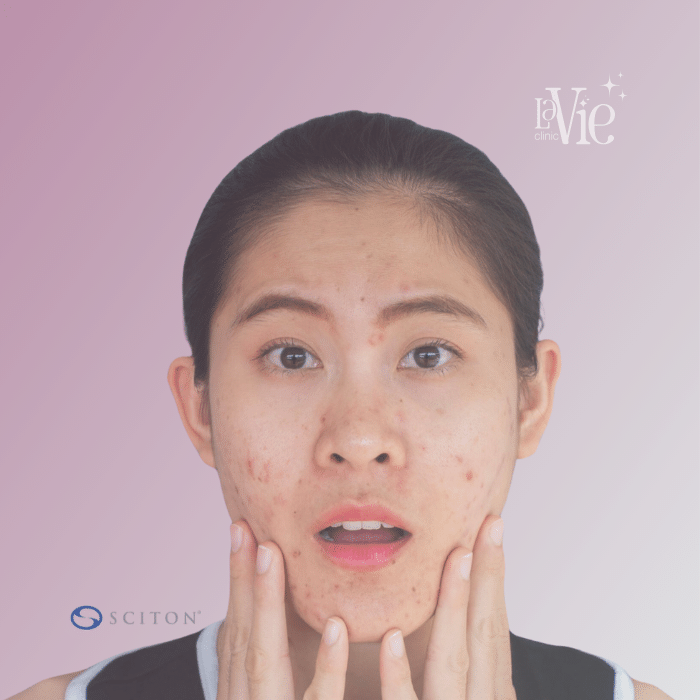 Forever Clear BBL Acne Treatment