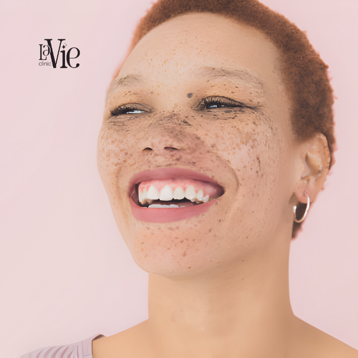 Get Your Skin Radiant With Freckles Removal Treatment in Rochester Hills MI