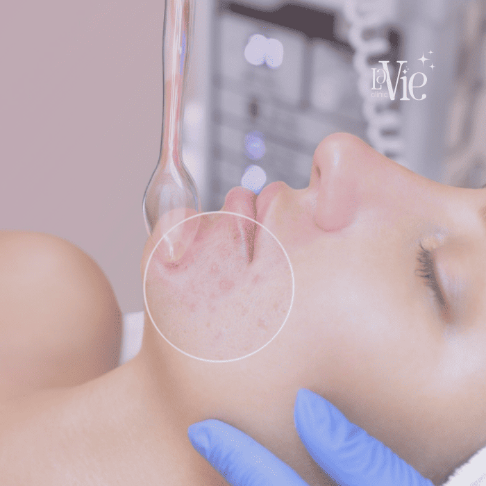 Acne Pigmentation Laser Treatment
