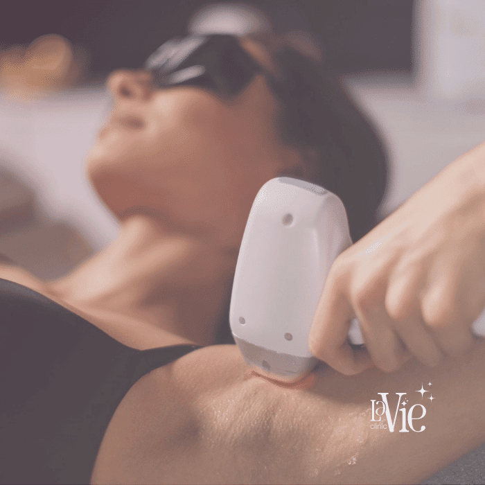 Laser Hair Removal