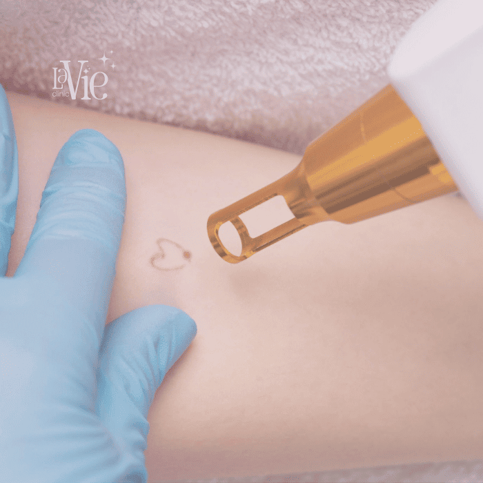 Laser Tattoo Removal
