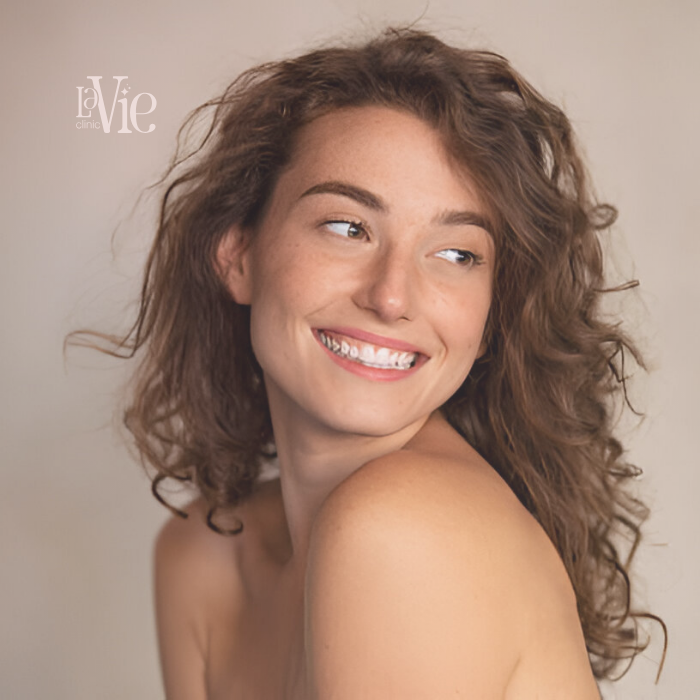 Melasma Treatment