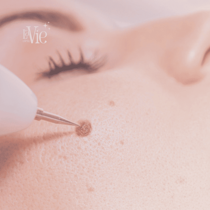 Mole Removal