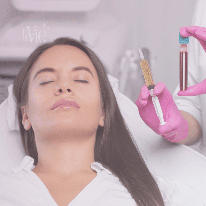 PRP Facial Rejuvenation