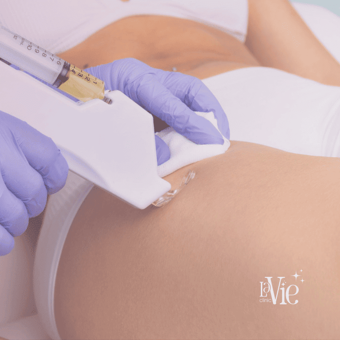 Body Microneedling