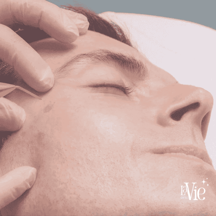 Fibroblast Non-Surgical Facelift Treatment