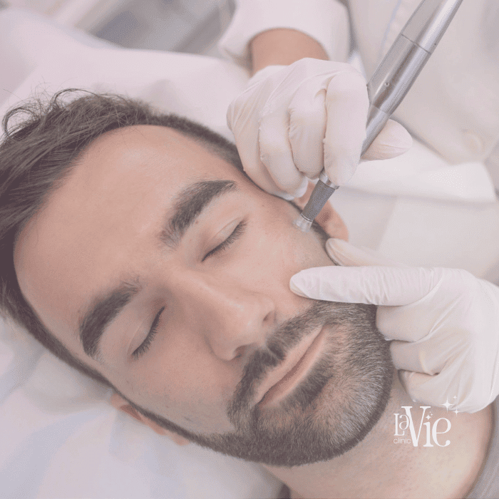 Microneedling