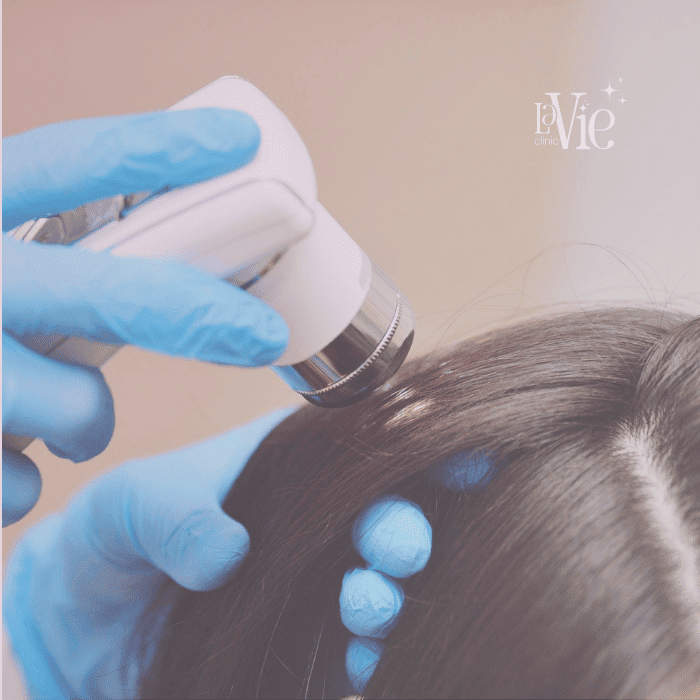 platelet-rich fibrin (PRF) for hair